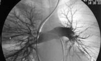 Дифференциальная диагностика и лечение тромбоэмболии легочной артерии